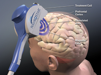 Electrical Stimulation (TENS) - Headache & Pain Center of Palm Beach